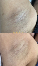 Depilação A Laser - Natacha Ianiski